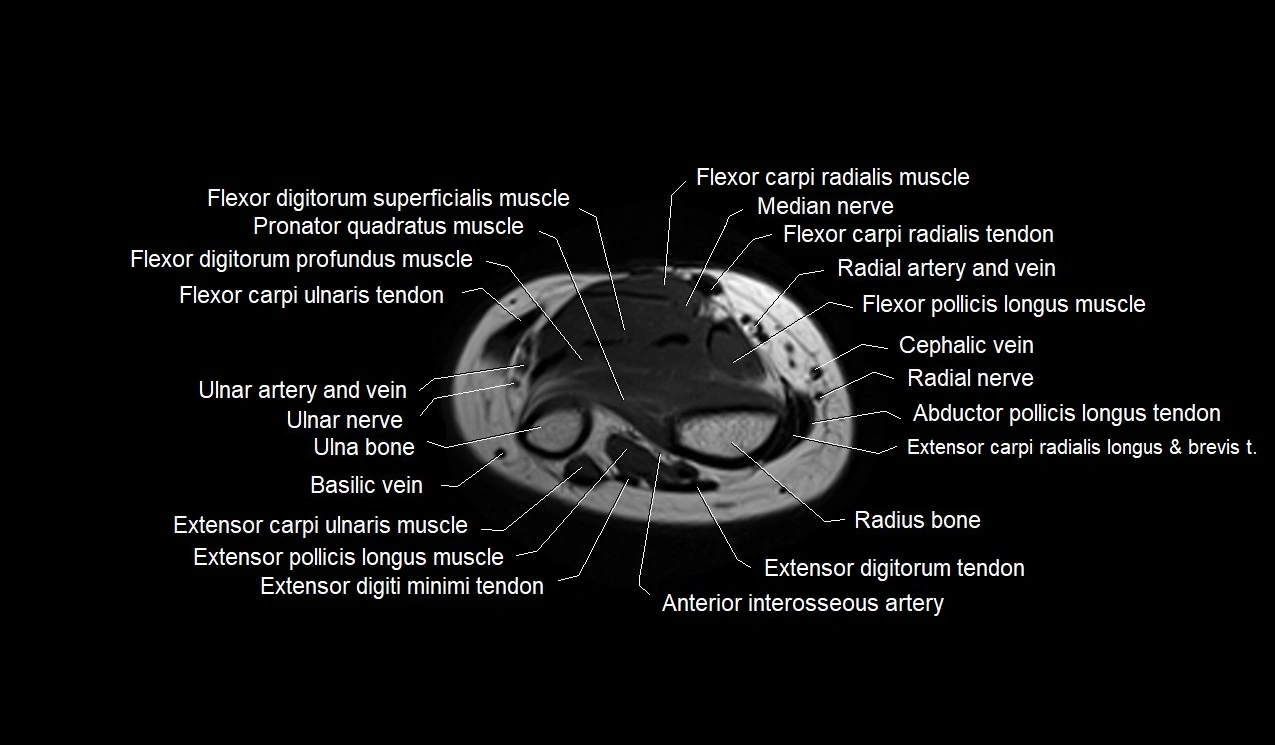 MRI 3T forearm axial cross sectional anatomy image 41.webp